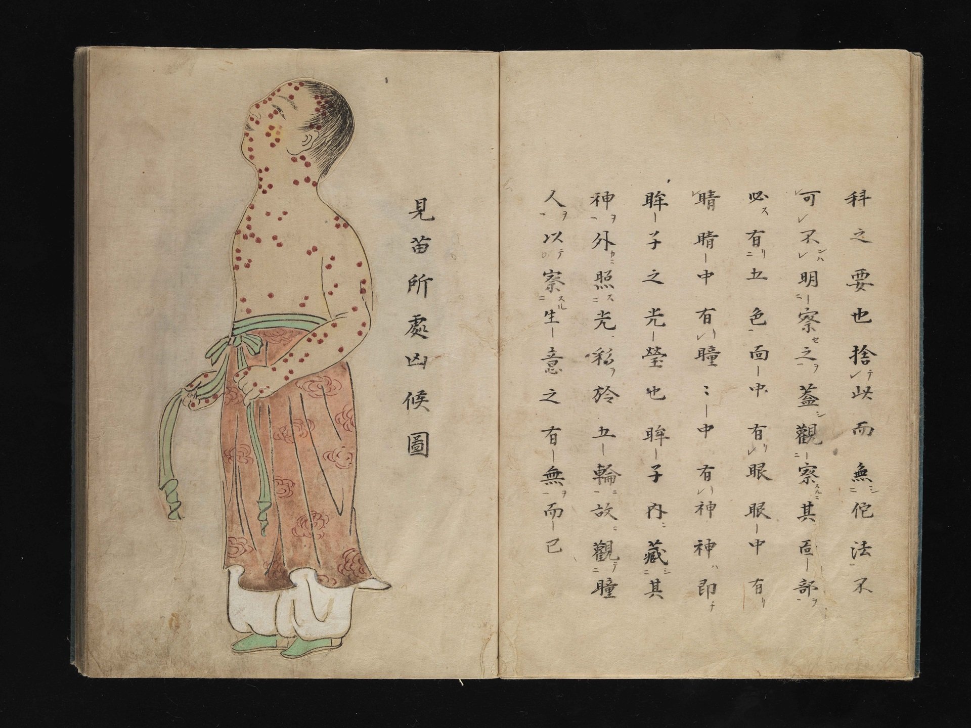 Smallpox-1720-Japan-Illustration Ancient Japanese illustration of smallpox